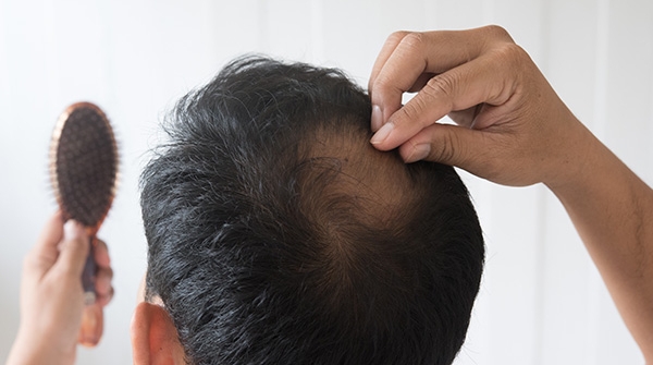 Les raisons de la chute des cheveux