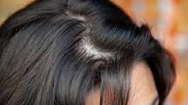 Conseils et astuces pour rendre vos cheveux moins gras